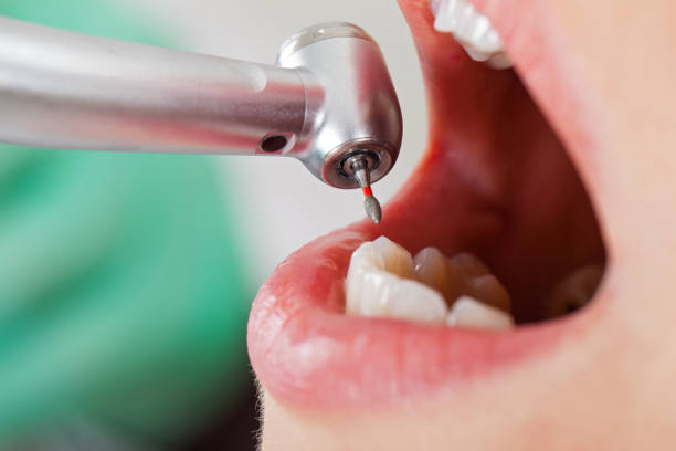 Best Emergency Root Canal Treatment in Oak Brook, IL
